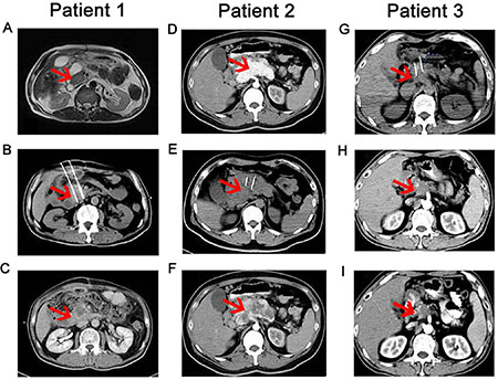 CT scans taken before, during and after IRE-NK therapy.