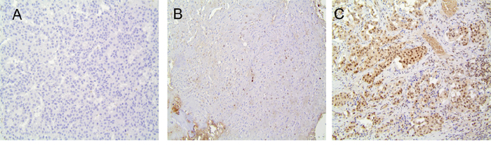 MGMT Expression by Immunohistochemistry (IHC).