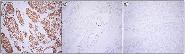 Examples of p53 expression in esophageal adenocarcinoma.