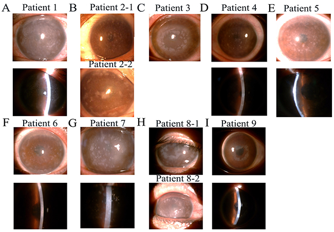 Slit-lamp photographs of patients from nine families with macular corneal dystrophy (MCD).