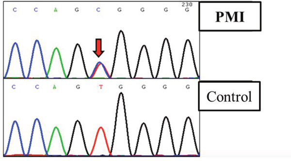 Truncated sequencing chtomatogramof SCAP of a patient diagnosed with PMI.