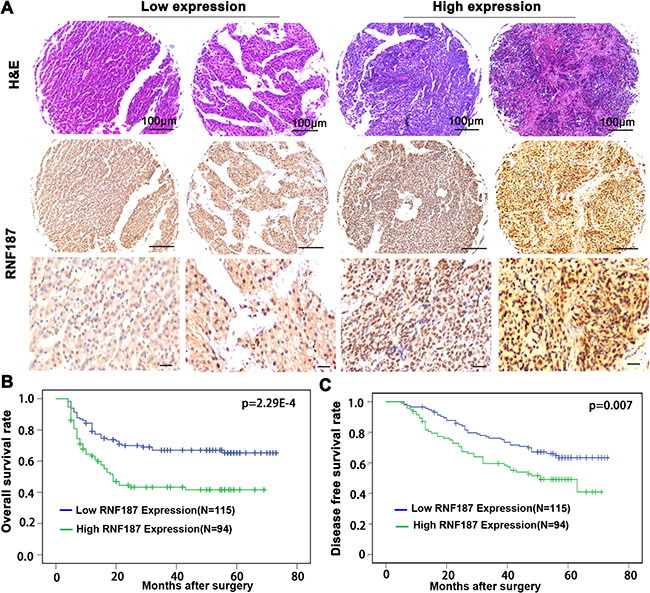 RNF187 overexpression is associated with the poorer survival of HCC patients.