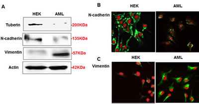 AML cells express less of N-cadherin and higher of vimentin proteins compared to HEK293 cells.