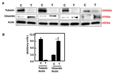 Deficiency of tuberin results in increased vimentin protein expression in tumor kidney tissue of TSC patients.