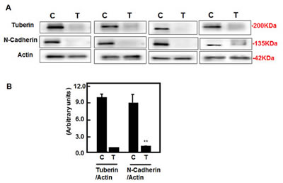 Deficiency of tuberin results in decreased N-cadherin protein expression in tumor kidney tissue of TSC patients.