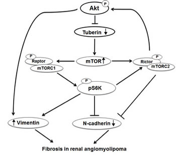 Proposed model of regulation of N-cadherin and vimentin in kidney angiomyolipoma.