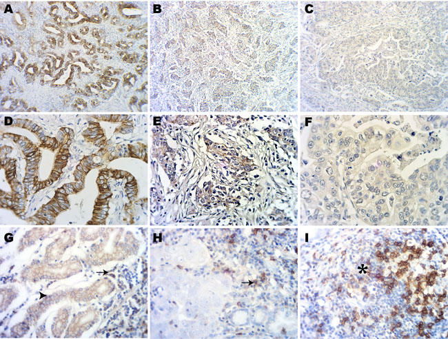 Immunohistochemical staining of PD-L1 in gastric adenocarcinoma tissues.