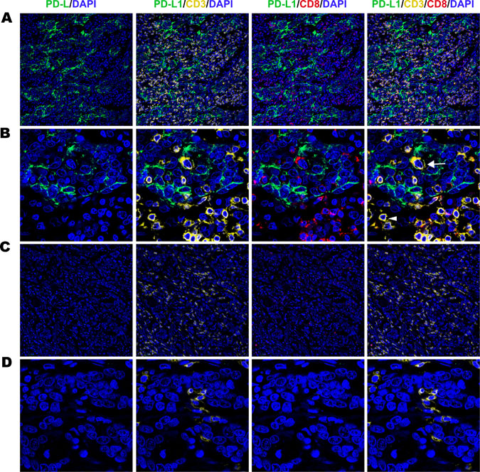 Fluorescent multiplex immunohistochemistry (mIHC) staining pattern for tumour cell PD-L1 and TILs in gastric adenocarcinoma tissues.