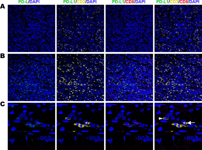 Fluorescent multiplex immunohistochemistry (mIHC) staining pattern for immune cell PD-L1 and TILs in gastric adenocarcinoma tissues.