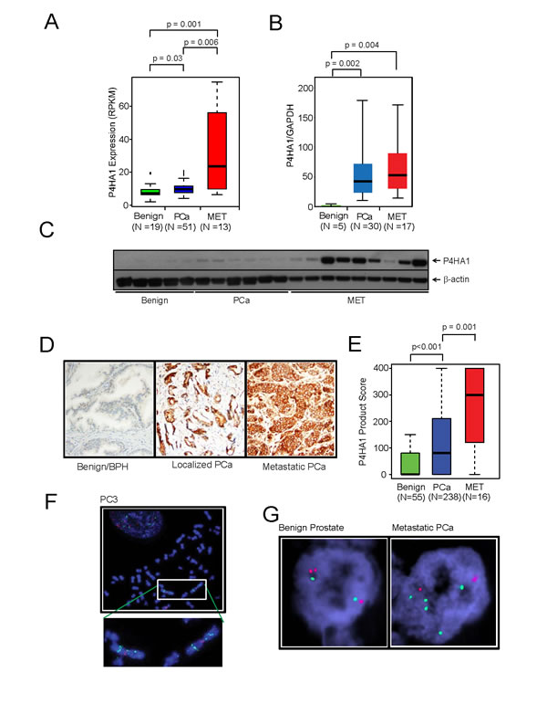 Collagen prolyl hydroxylase P4HA1 is overexpressed in prostate cancer and is associated with disease progression.