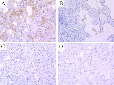 The typical IHC images of PD-L1 expression.