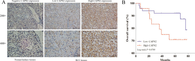 CAPN2 expression in normal kidney tissues and RCC TMAs, and its significance in prognosis of patients.