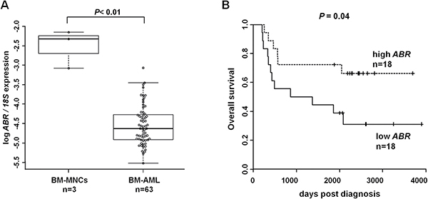 ABR expression is downregulated in acute myeloid leukemia (AML) and high ABR expression is associated with improved outcome.