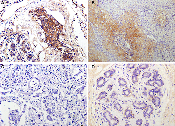 Representative immunohistochemical staining for DDEFL1 in breast cancer and paired normal breast tissue.
