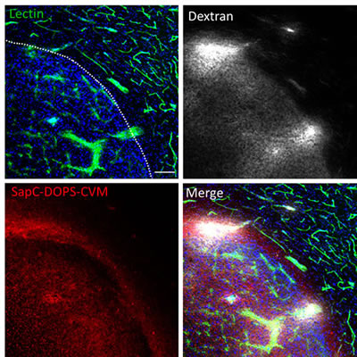 Glioblastoma vascularization and permeability.