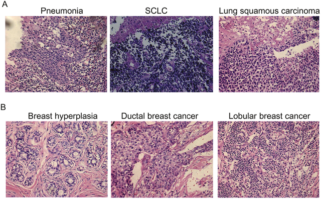 HE staining of cancer tissue and non-cancerous tissue.