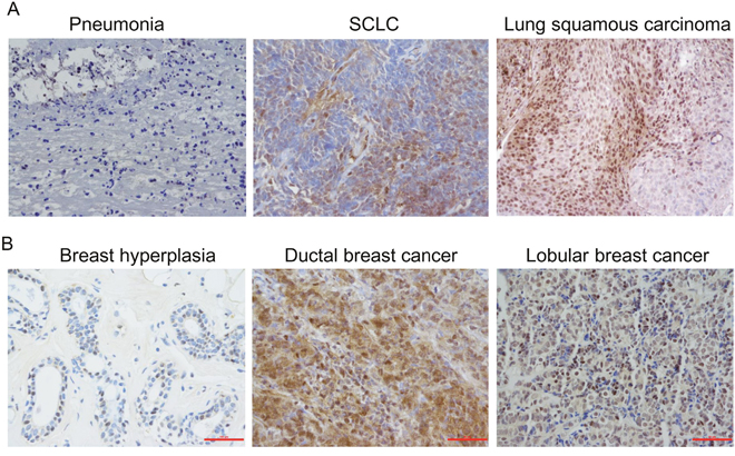 Immunohistochemical analysis of Jab1/COPS5 in cancer tissues.