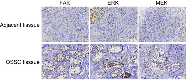FAK, ERK and MEK expressions in the OSCC tissues and the normal adjacent tissues (&times; 200).