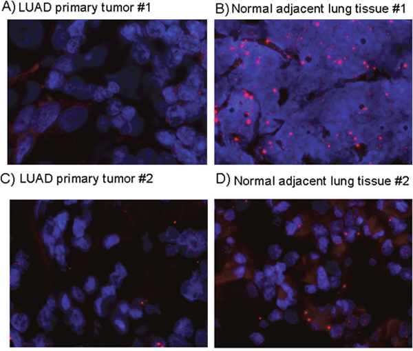 FENDRR expression detection by RNA-FISH in lung cancer and normal lung.