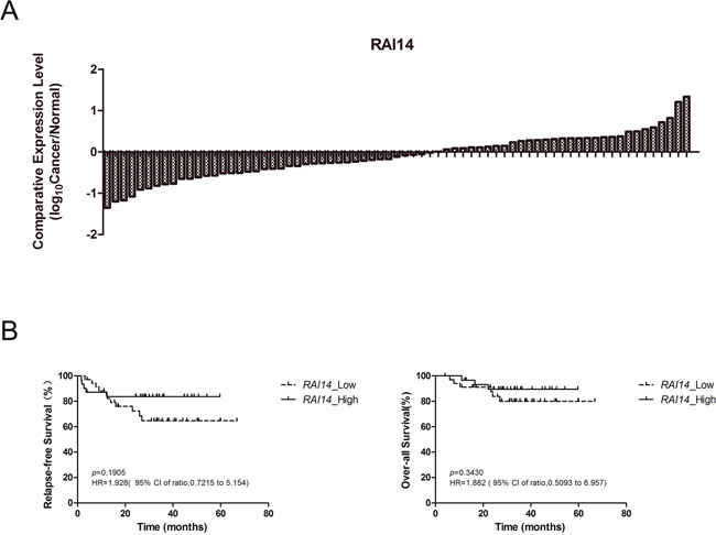 RAI14 expression status in 71 patients and cumulative probability of relapse-free survival and over-all survival for patients with lung adenocarcinoma.