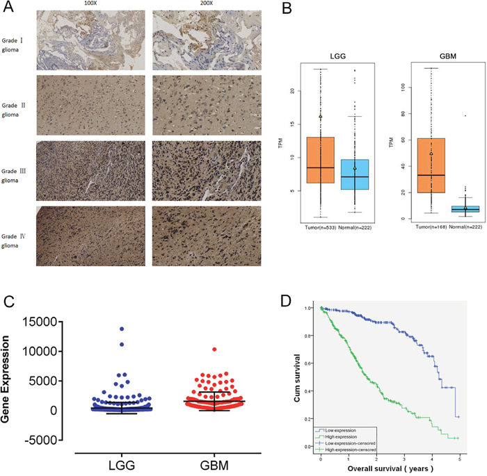 RDH10 is over-expressed in human gliomas and predicts a high grade and poor prognosis.