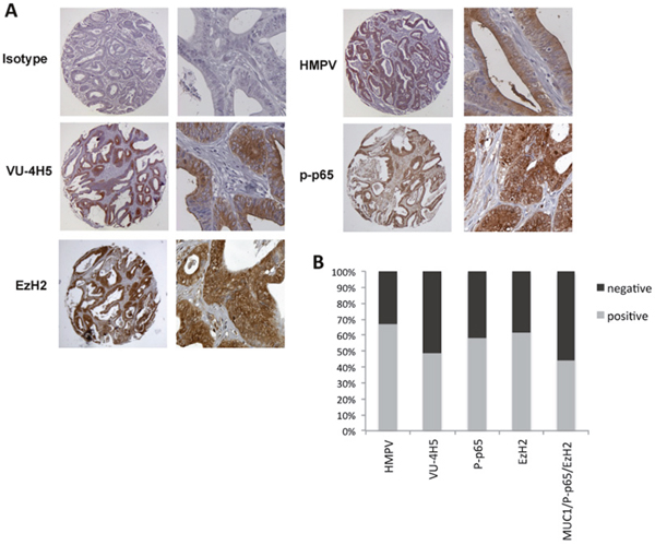 Co-expression of hypoglycosylated MUC1 with p-p65 and EzH2 in colon adenocarcinoma.