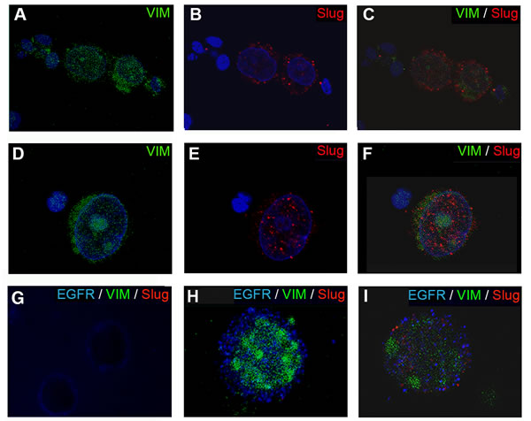 Epifluorescence microscopy images of CTCs stained for VIM and Slug expression.