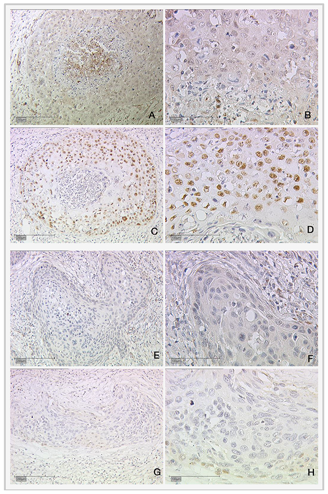 Expression of cytoplasmic RIP140 and nuclear mutated p53 in cervical cancer.
