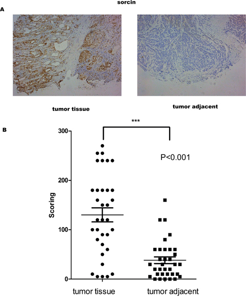 Sorcin levels were higher in GC tissue than in adjacent normal tissue.