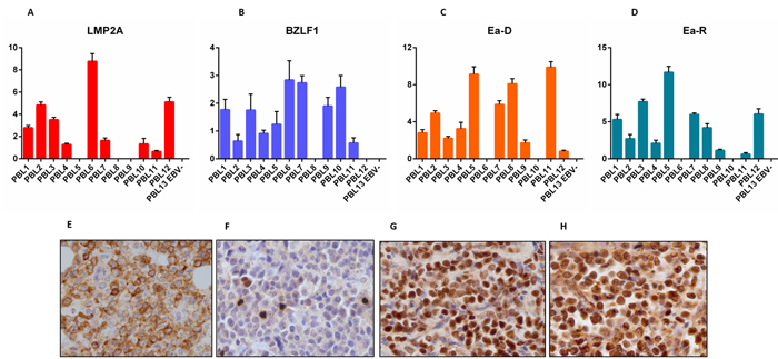 RT-qPCR and immunohistochemistry reveal a non-canonical latency type and an abortive lytic cycle of EBV in neoplastic cells.