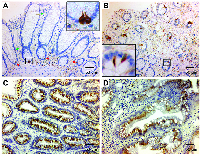 DCLK1 expression is increased in human colon adenomas and colorectal cancer.