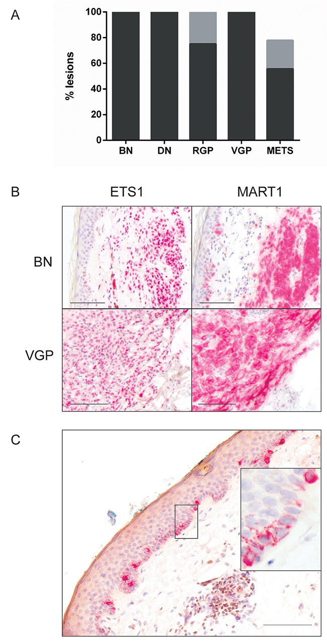 ETS1 expression with melanoma progression.