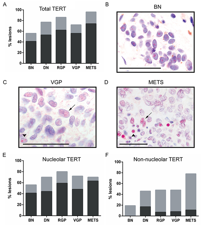 TERT expression and localization with melanoma progression.