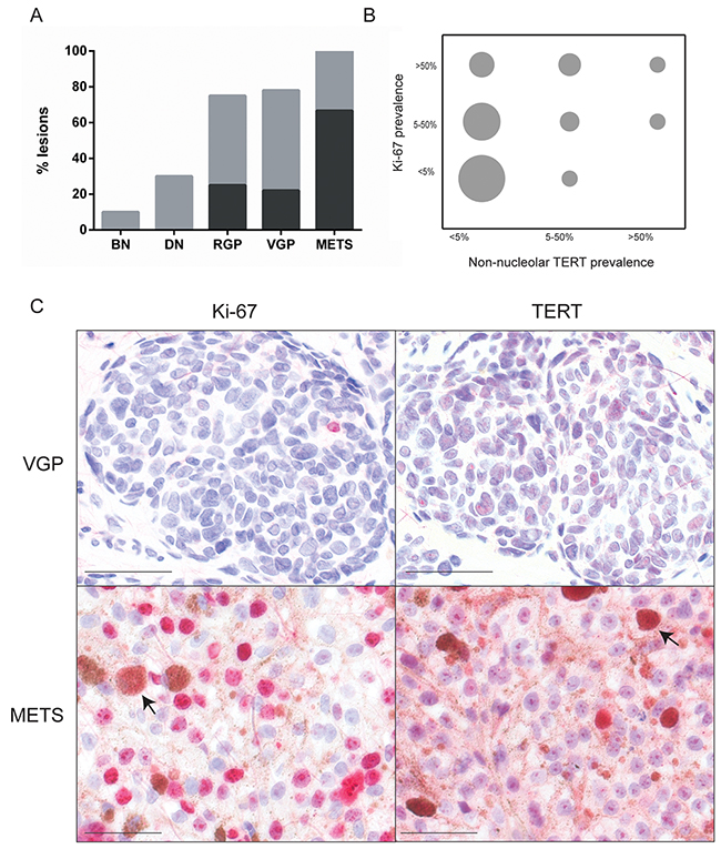 Ki-67 expression and lack of association with non-nucleolar TERT.