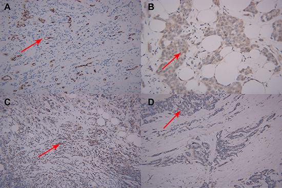 Microscopic manifestations of IHC in a patient with breast cancer same to Figure 1.