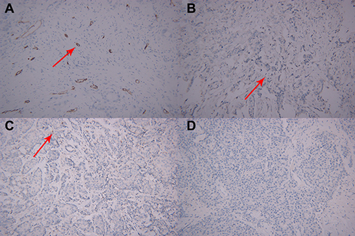 Microscopic manifestations of IHC in a patient with breast cancer same to Figure 2.