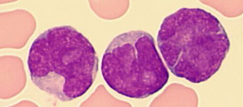 Small cells containing distinct nucleoli, irregular nuclei, and slightly basophilic cytoplasm (classical form) (MGG, X 100).