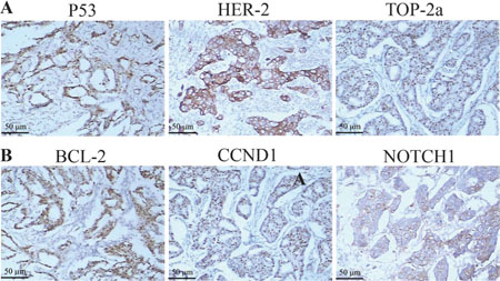 The expression of HER-2, TOP2A, P53, BCL-2, CCND1, NOTCH1 protein were by immunohistostaining