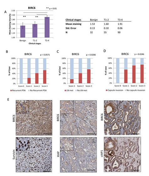 Elevated BIRC6 expression is associated with advanced stages of prostate cancer: co-upregulation of other IAP members.