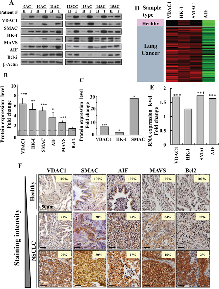 Over-expression of VDAC1 and other apoptosis- and energy-related proteins in lung cancer patients.