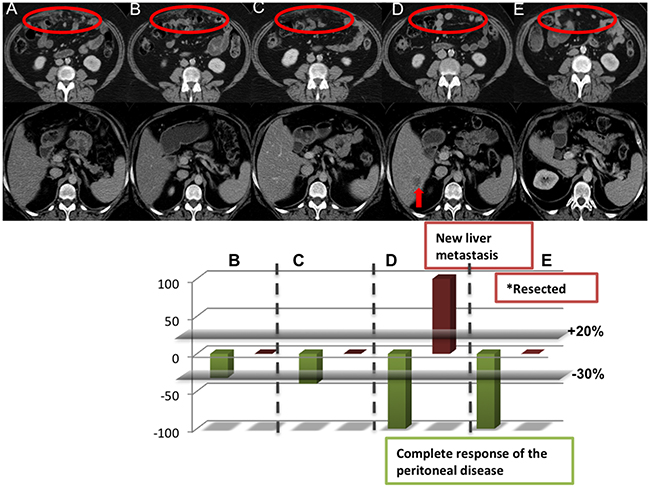 Tumor characterization of a PARP inhibitor responder with RDR.