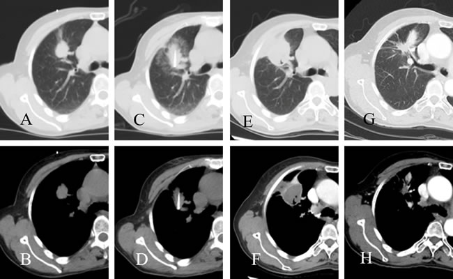 CT images of a patient who underwent radiofrequency ablation.