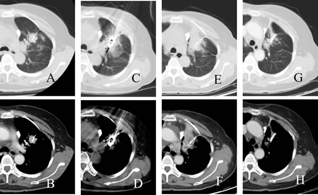 CT images of a patient who underwent microwave ablation.