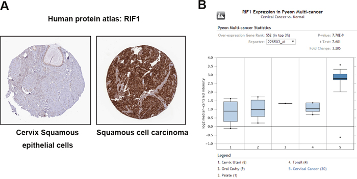 RIF1 is upregulated in human cervical carcinoma specimens.