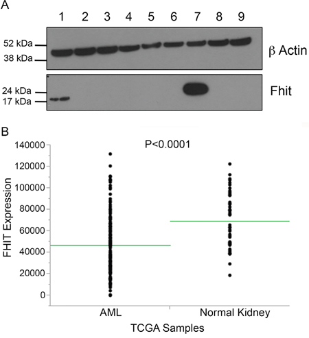 Fhit expression in Acute Myelogenous Leukemias, a cancer exhibiting only mutational signatures 1 and 5.