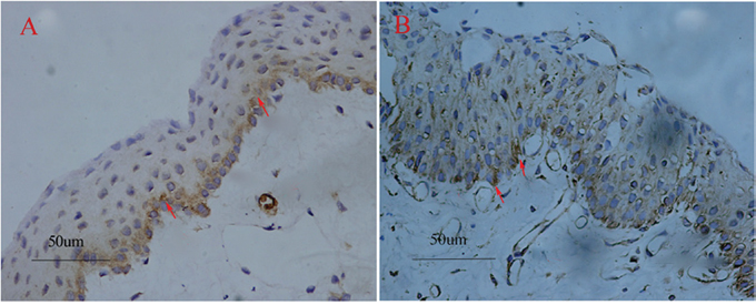 Pterygium tissues stained with COX-2 and VEGF.