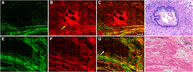 The top row shows the nonlinear optical images of tumor response to neoadjuvant therapy with fibrosis changes and corresponding H&#x0026;E-stained image.