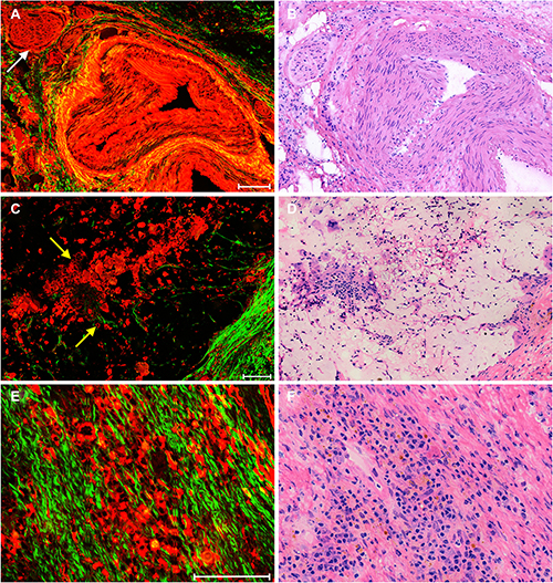 Representative nonlinear optical images of stromal response after neoadjuvant therapy in rectal carcinoma and corresponding H&#x0026;E-stained images.