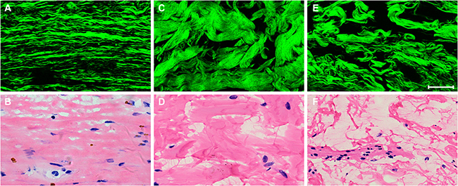 Representative nonlinear optical images of three types of fibrotic response after neoadjuvant therapy in rectal carcinoma and corresponding H&#x0026;E-stained images.