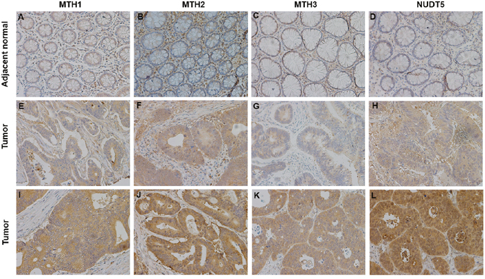 Representative immunohistochemical staining for MTH1, MTH2, MTH3 and NUDT5 expression in CRC specimens (X200).
